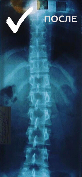 Лечение сколиоза у детей Баку