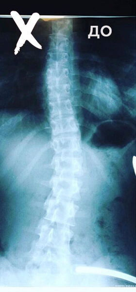 Лечение сколиоза у детей Баку